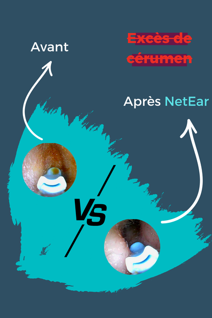 EarCleaner™ | Kits d'extraction des bouchons de cérumen avec caméra